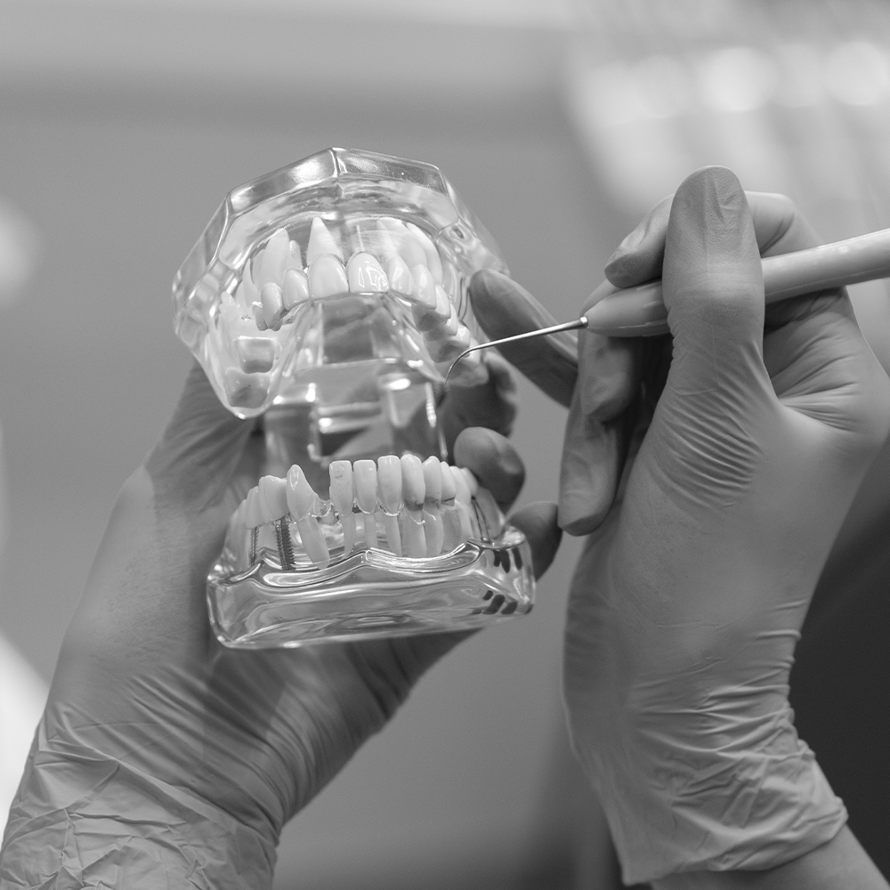 Rehabilitación sobre implantes