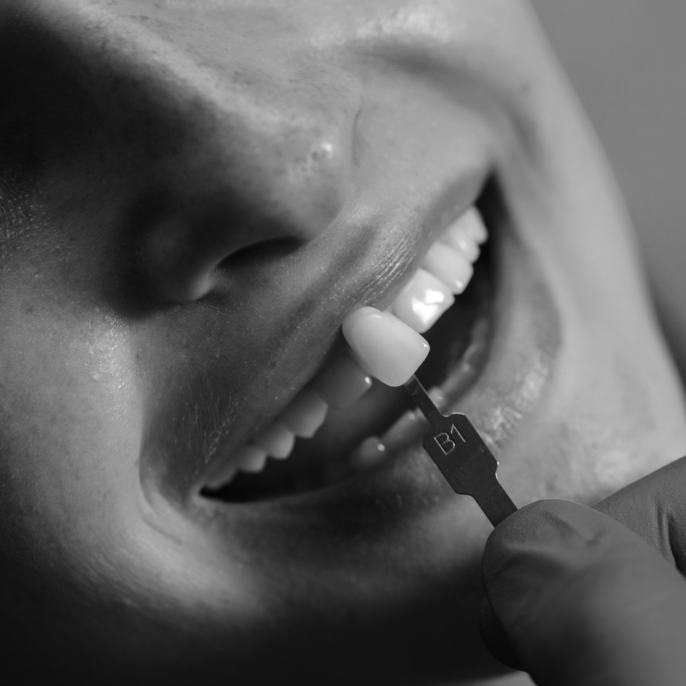 Implantes dentales