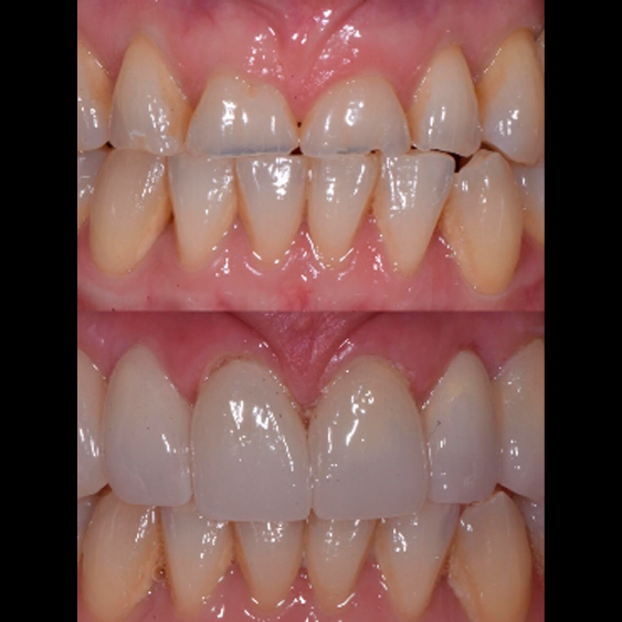 Resultado de diseño de sonrisa digital — Smile Gallery