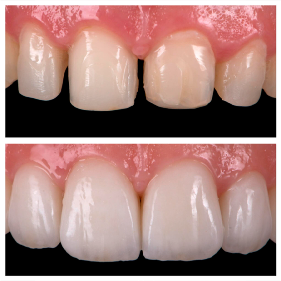 Carillas de porcelana — Smile Gallery Polanco
