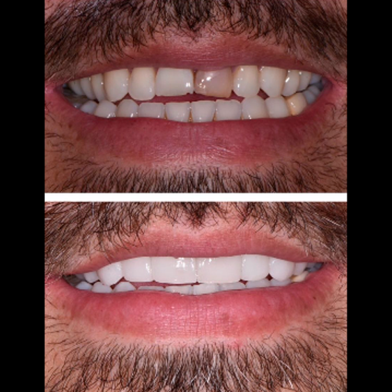 Implante dental — Smile Gallery CDMX
