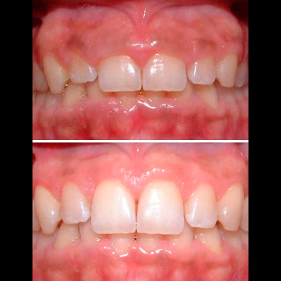 Blanqueamiento dental profesional — Smile Gallery