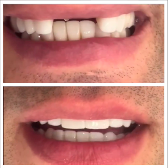 Ortodoncia digital — Smile Gallery Polanco