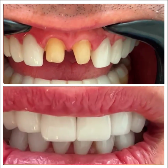 Rehabilitación oral — Smile Gallery CDMX