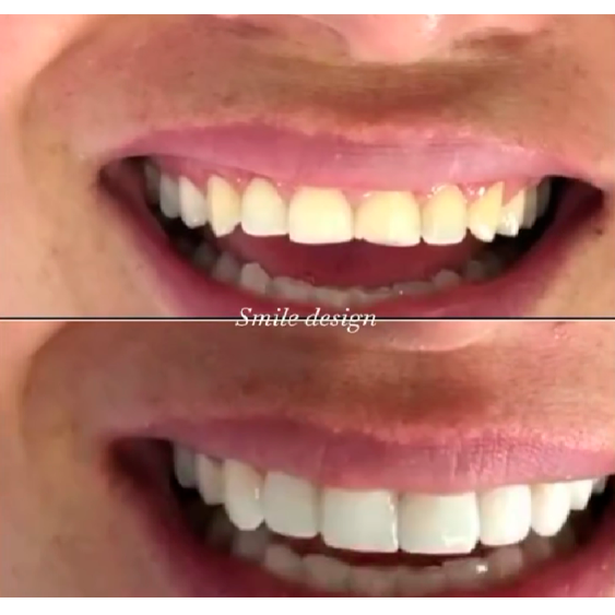 Diseño de sonrisa — Smile Gallery Polanco