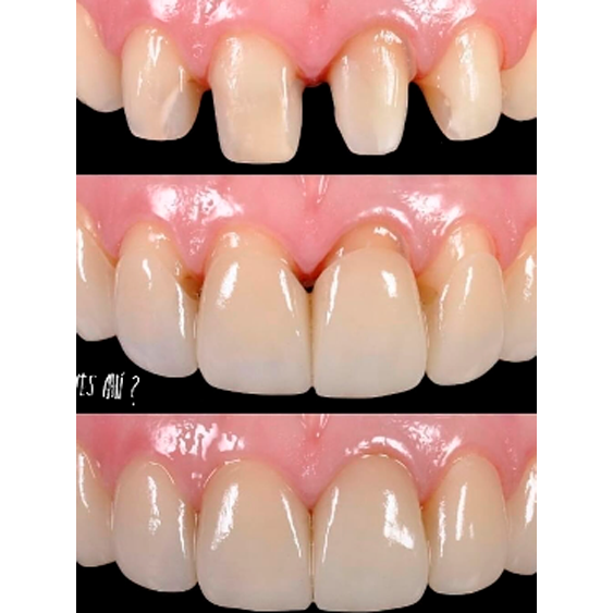 Tratamiento dental estético — Smile Gallery